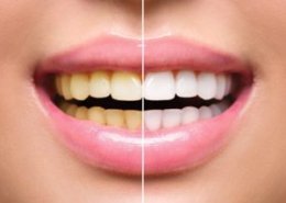 Teeth Whitening Las Vegas