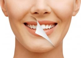 teeth whitening north las vegas